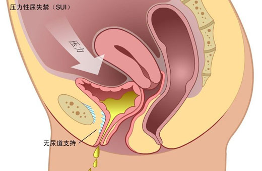 盆底康復(fù)之慢肌、快肌訓(xùn)練篇